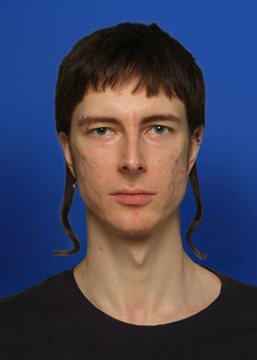 After Rhinoplasty - Front View